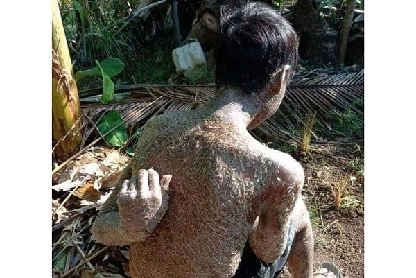 Viral Tubuh Warga Indramayu Bersisik, Sebenarnya Penyakit Apa?