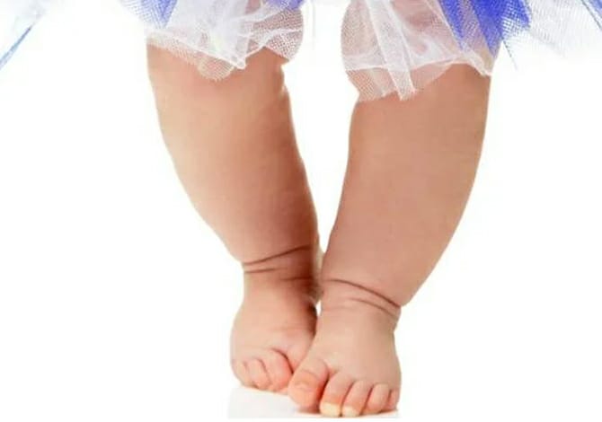 Cara Pencegahan Kaki O pada Bayi